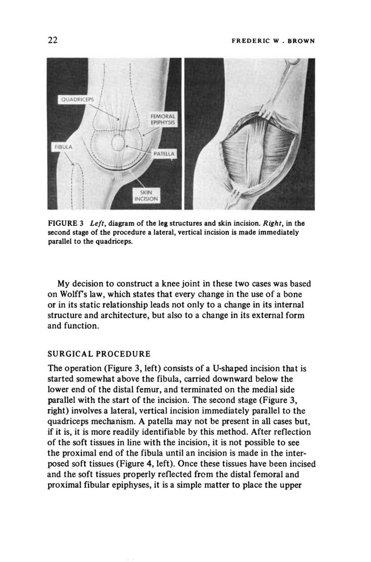 fibular hemimelia diagram
